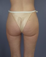 Liposuction