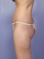 Liposuction Before and after photo