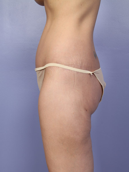 Liposuction before and after photo