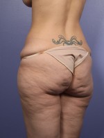 Liposuction Before and after photo