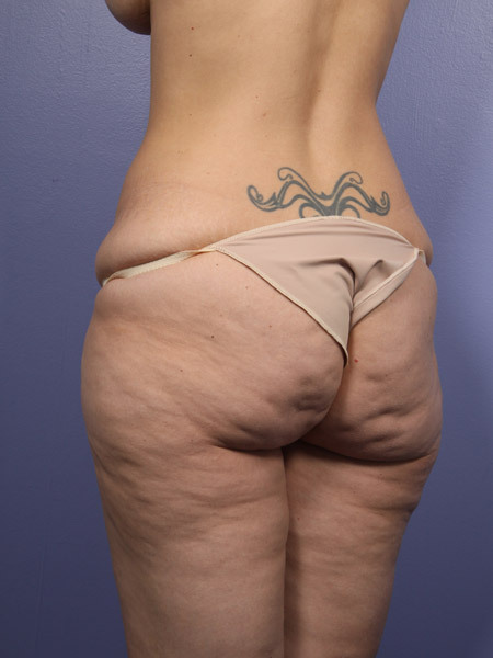 Liposuction before and after photo