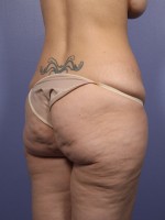 Liposuction Before and after photo