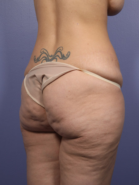 Liposuction before and after photo