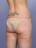 Liposuction Before and after photo