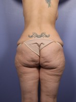 Liposuction Before and after photo