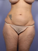 Liposuction Before and after photo