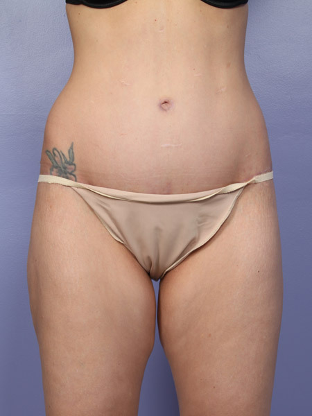 Liposuction before and after photo