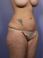 Liposuction Before and after photo