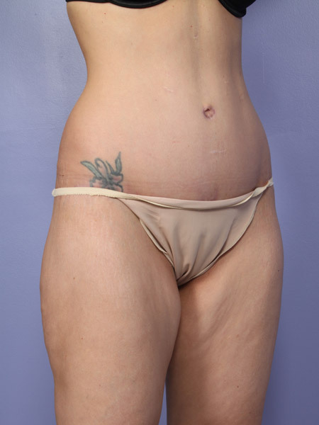 Liposuction before and after photo