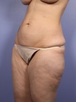 Liposuction Before and after photo