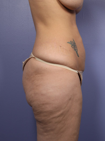 Liposuction before and after photo