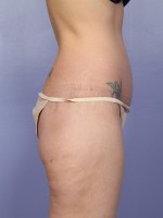 Liposuction Before and after photo