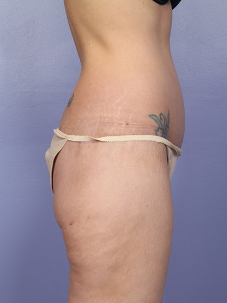 Liposuction before and after photo