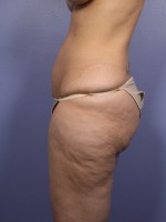 Liposuction Before and after photo