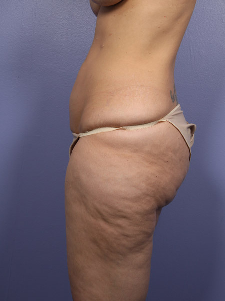 Liposuction before and after photo