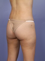 Liposuction Before and after photo