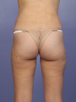 Liposuction Before and after photo