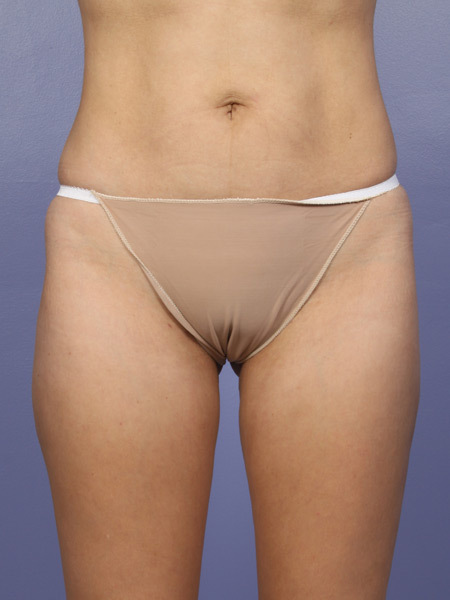Liposuction before and after photo
