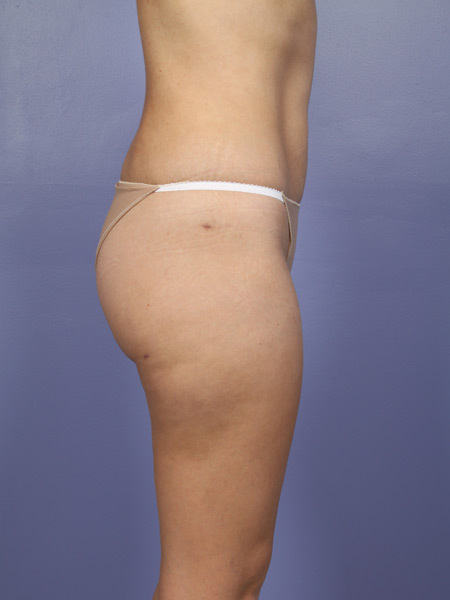 Liposuction before and after photo