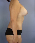 Liposuction Before and after photo