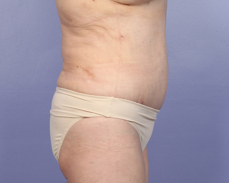 Liposuction before and after photo