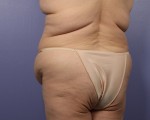 Liposuction Before and after photo