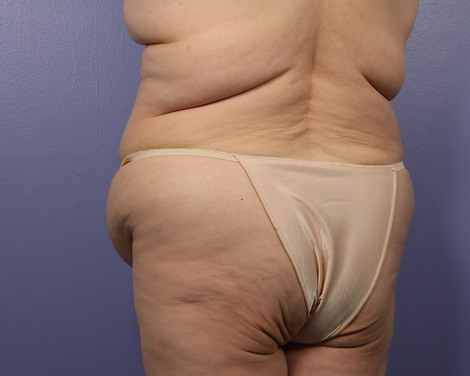 Liposuction before and after photo