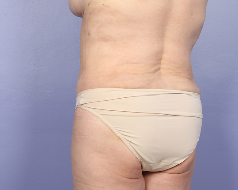 Liposuction before and after photo