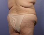 Liposuction Before and after photo