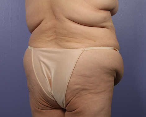 Liposuction before and after photo