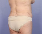 Liposuction Before and after photo