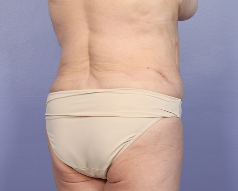 Liposuction before and after photo