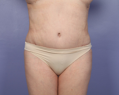 Liposuction before and after photo