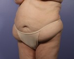 Liposuction Before and after photo