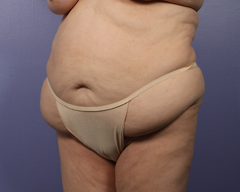 Liposuction before and after photo