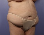 Liposuction Before and after photo