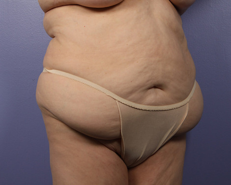 Liposuction before and after photo