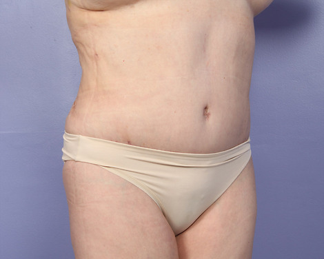 Liposuction before and after photo