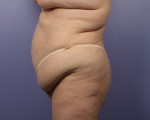 Liposuction Before and after photo