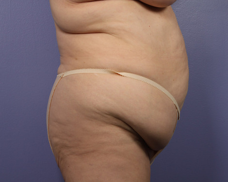 Liposuction before and after photo