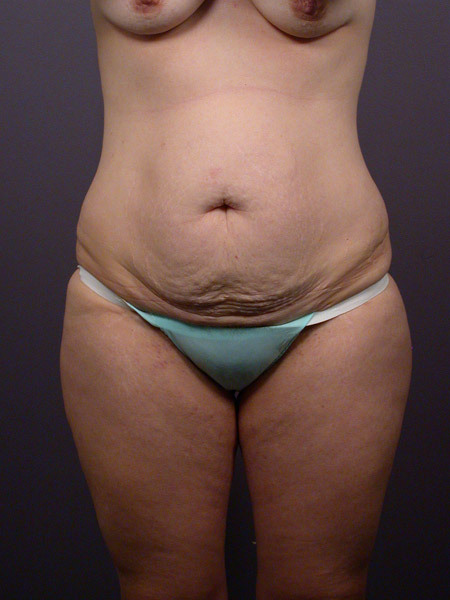 Liposuction before and after photo