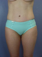 Liposuction Before and after photo