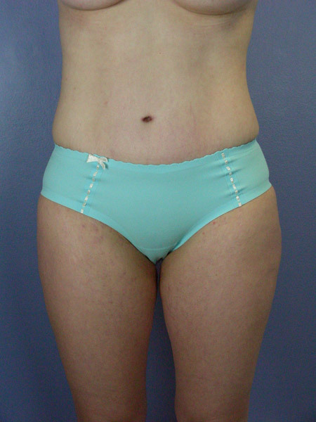 Liposuction before and after photo