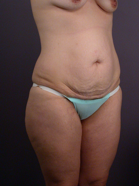 Liposuction before and after photo