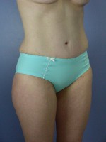 Liposuction Before and after photo