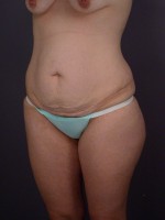 Liposuction Before and after photo