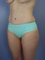 Liposuction Before and after photo