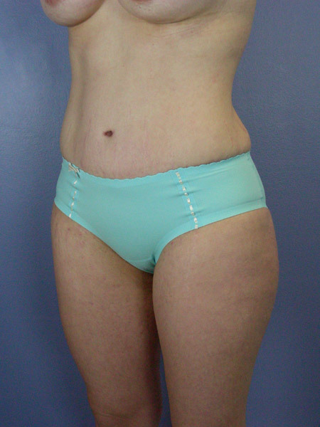 Liposuction before and after photo