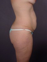 Liposuction Before and after photo