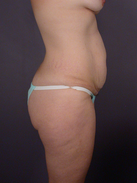 Liposuction before and after photo